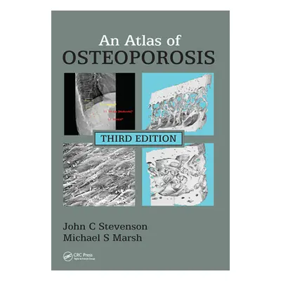 "An Atlas of Osteoporosis" - "" ("Stevenson John C.")