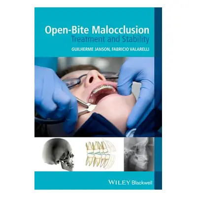 "Open-Bite Malocclusion: Treatment and Stability" - "" ("Janson Guilherme")