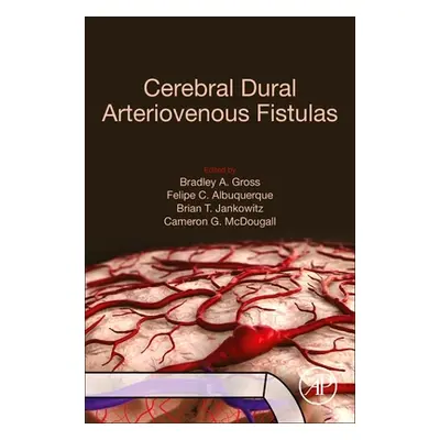 "Cerebral Dural Arteriovenous Fistulas" - "" ("Gross Bradley A.")