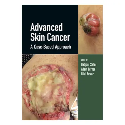 "Advanced Skin Cancer: A Case-Based Approach" - "" ("Sahni Debjani")